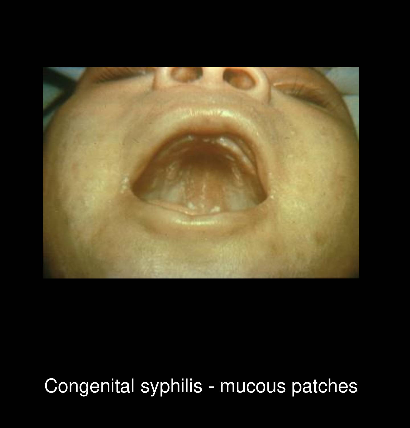 Primary syphilis chancre on glans penis showing solitary painless indurated ulcer with clean base and raised borders diagnostic of Treponema pallidum